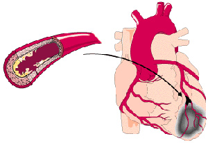 Что такое инфаркт сердца