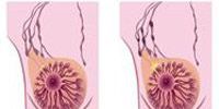 Первые признаки рака молочной железы у женщин