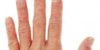 Проблемы сухой кожи рук, что делать