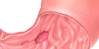 Что такое язва желудка и как она проявляется