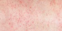 Чем отличается инфекционная сыпь от аллергической