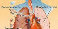 Что такое бронхиальная астма и как с ней бороться